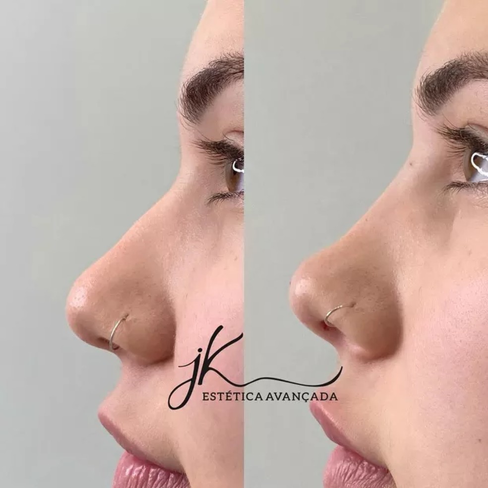 Antes e depois da rinomodelação de Virginia Fonseca — Foto: Reprodução / Instagram