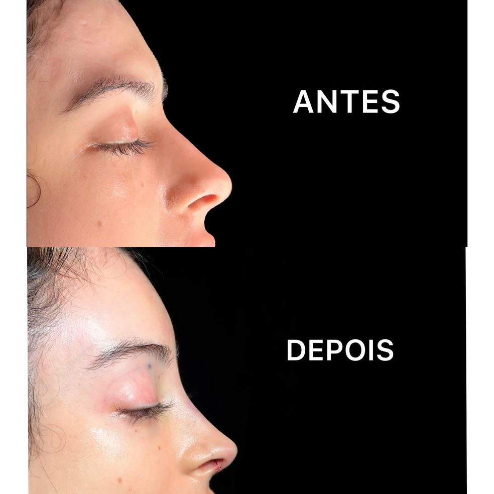 Zé Longuinho mostra antes e depois de procedimento estético — Foto: Reprodução/Instagram