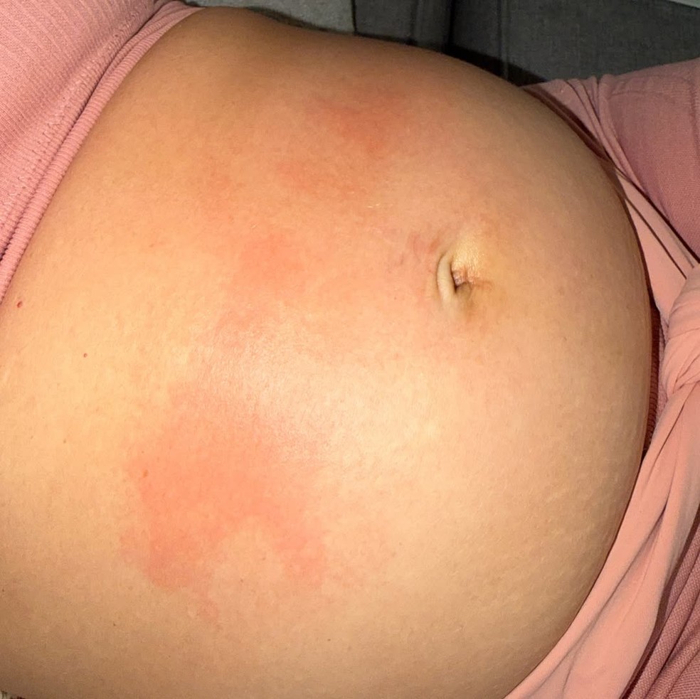 Patrícia Leitte mostra manchas na barriga e cogita: 'Urticária gravídica?'