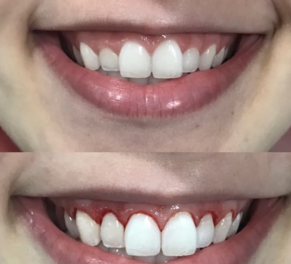 Gengivoplastia de Virginia Fonseca — Foto: Reprodução/Instagram