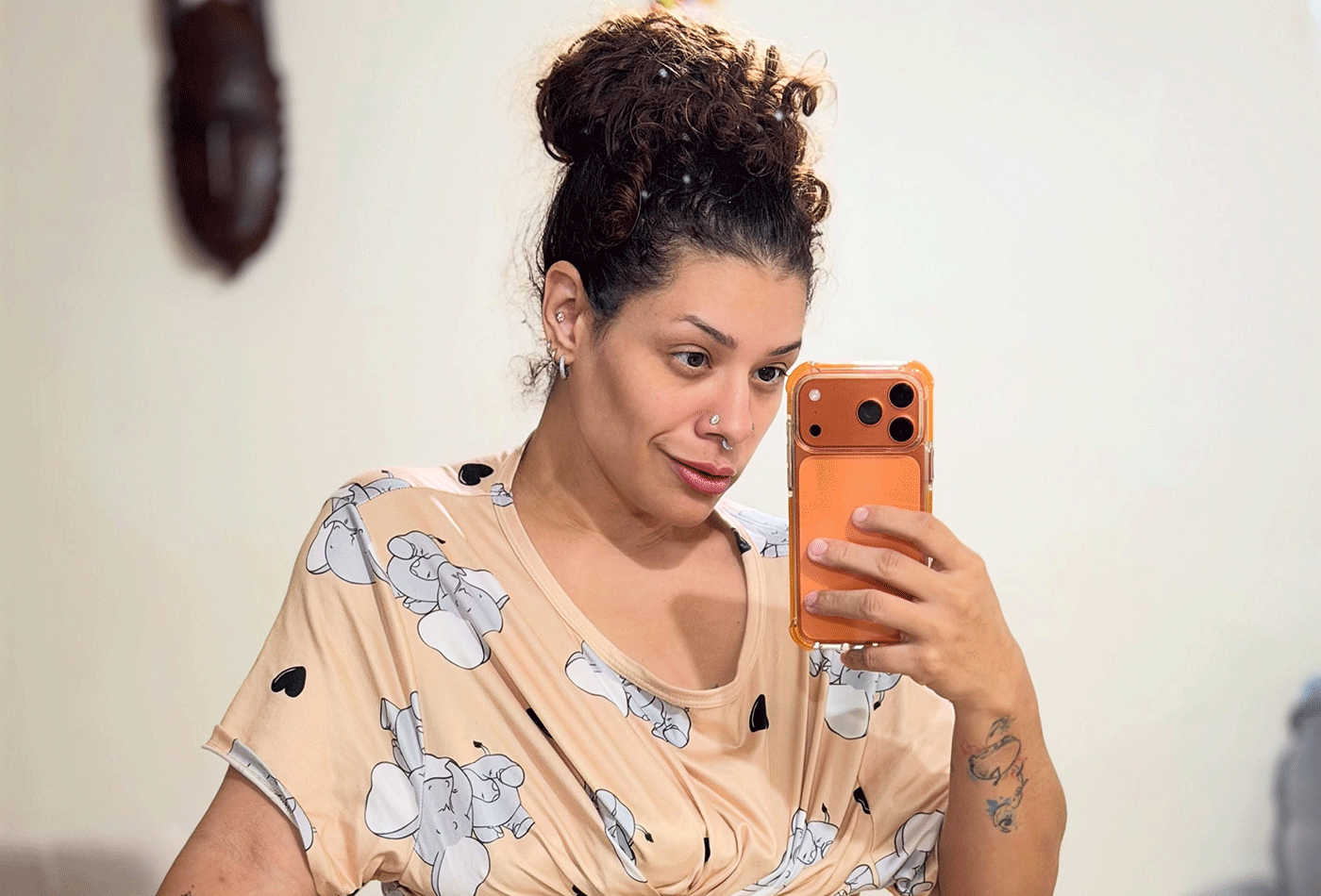 Ex-The Voice mostra cicatrizes de abdominoplastia após perder 90 kg: 