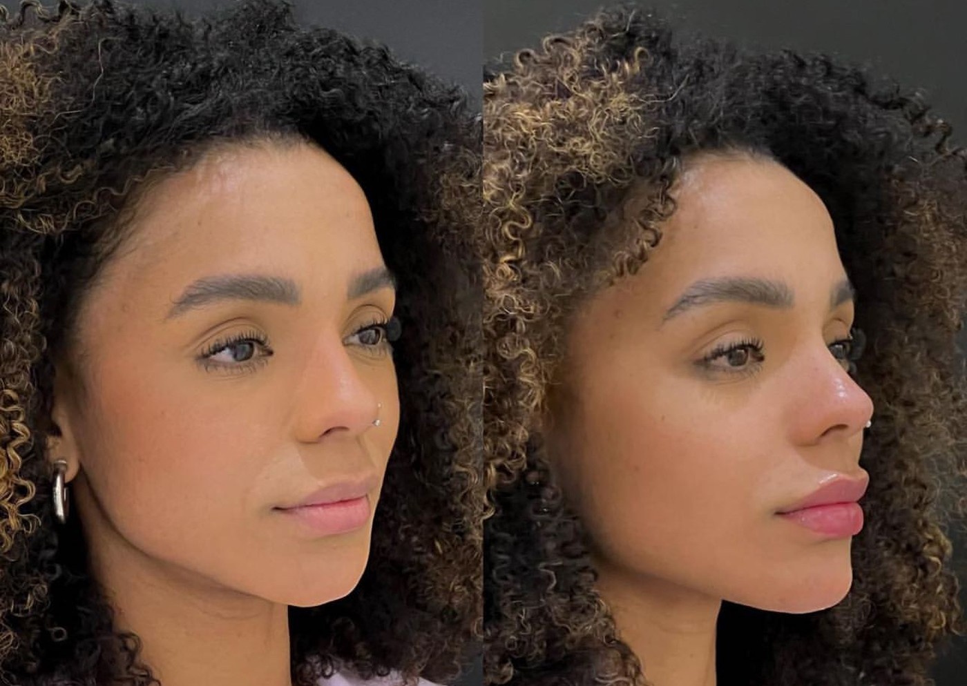 Antes e depois de harmonização facial de Brunna Gonçalves — Foto: Reprodução/Instagram