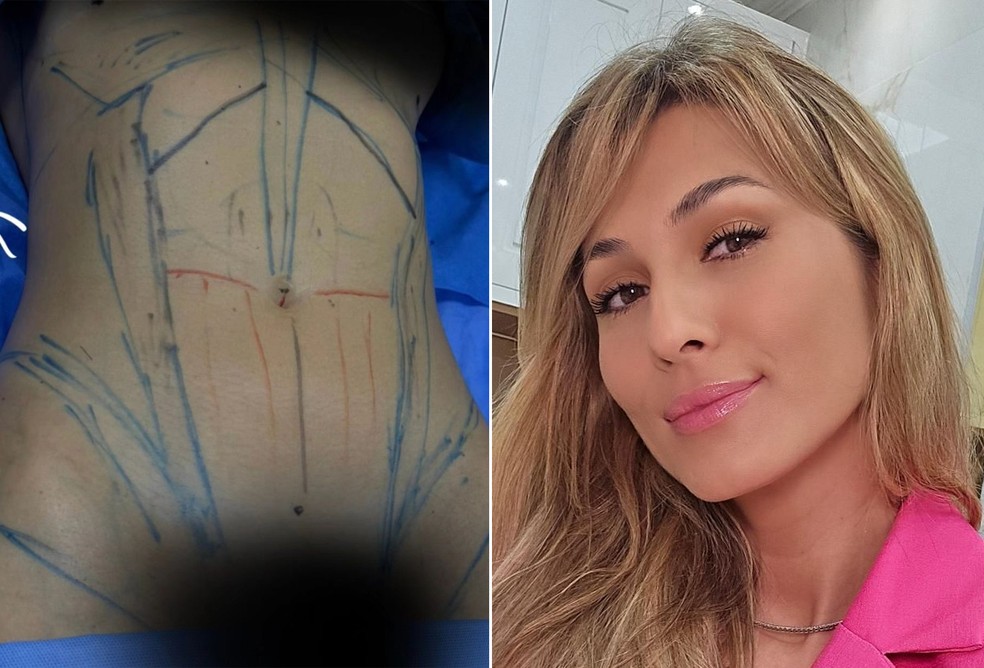 Lívia Andrade antes da lipo LAD — Foto: Reprodução/Instagram