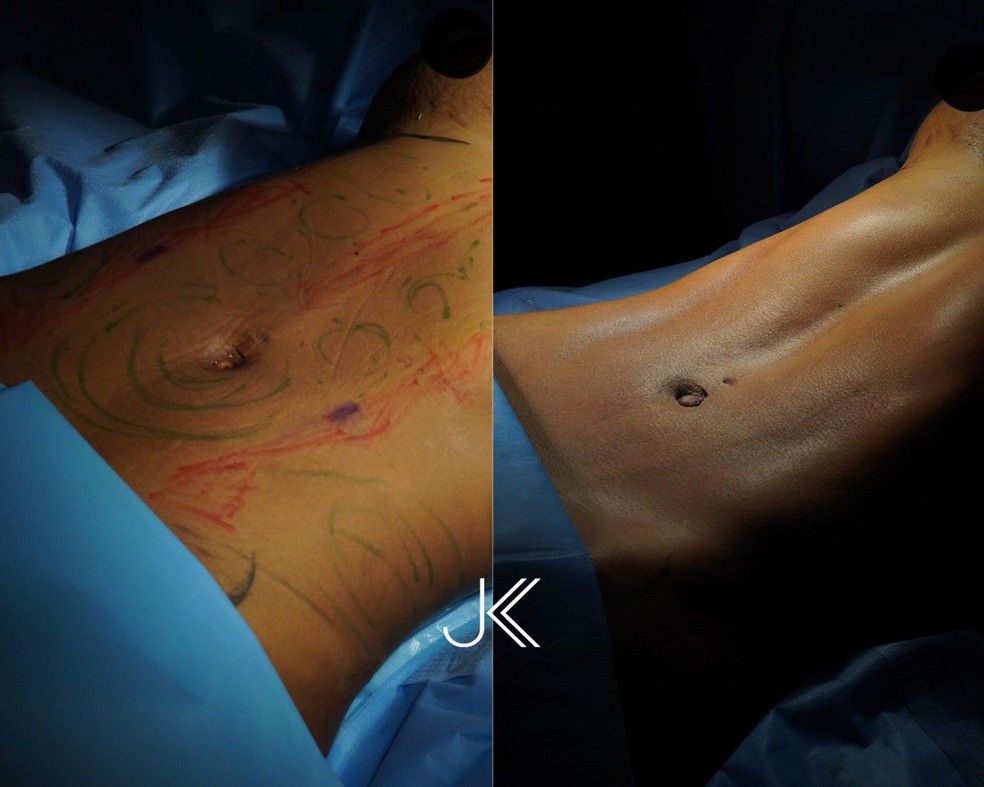Antes e depois da cirurgia estética de Lorena Maria — Foto: Divulgação