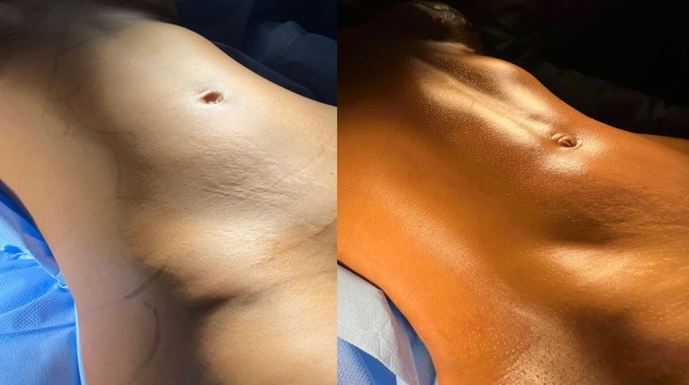 Mileide Mihaile mostra antes e depois de lipo LAD — Foto: Reprodução/Instagram