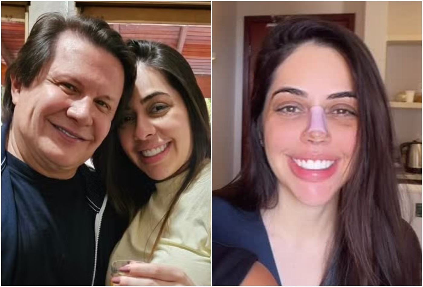 Namorada de Giovani mostra resultado de rinoplastia após tirar curativo: 'Chorei'; veja e compare - Foto