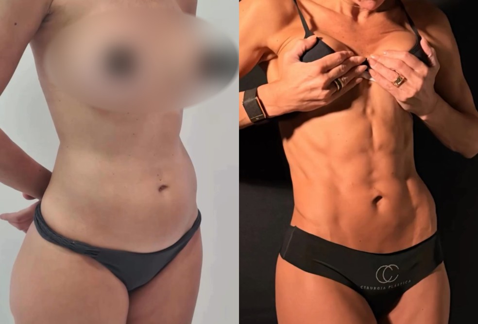 Ketryn Goetten antes e depois da Lipo HD — Foto: Reprodução/Instagram