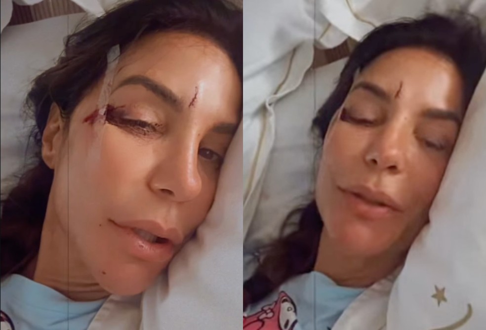 Ivete Sangalo no dia da queda — Foto: Reprodução/Instagram