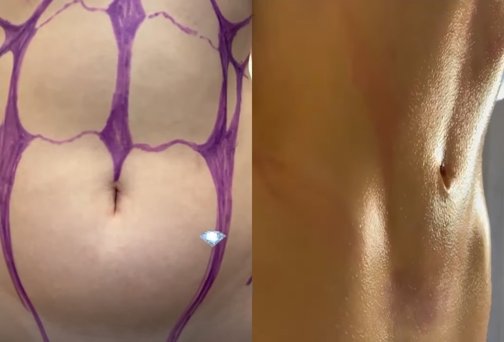 Antes e depois do abdômen de Bella Angel — Foto: Reprodução: Instagram