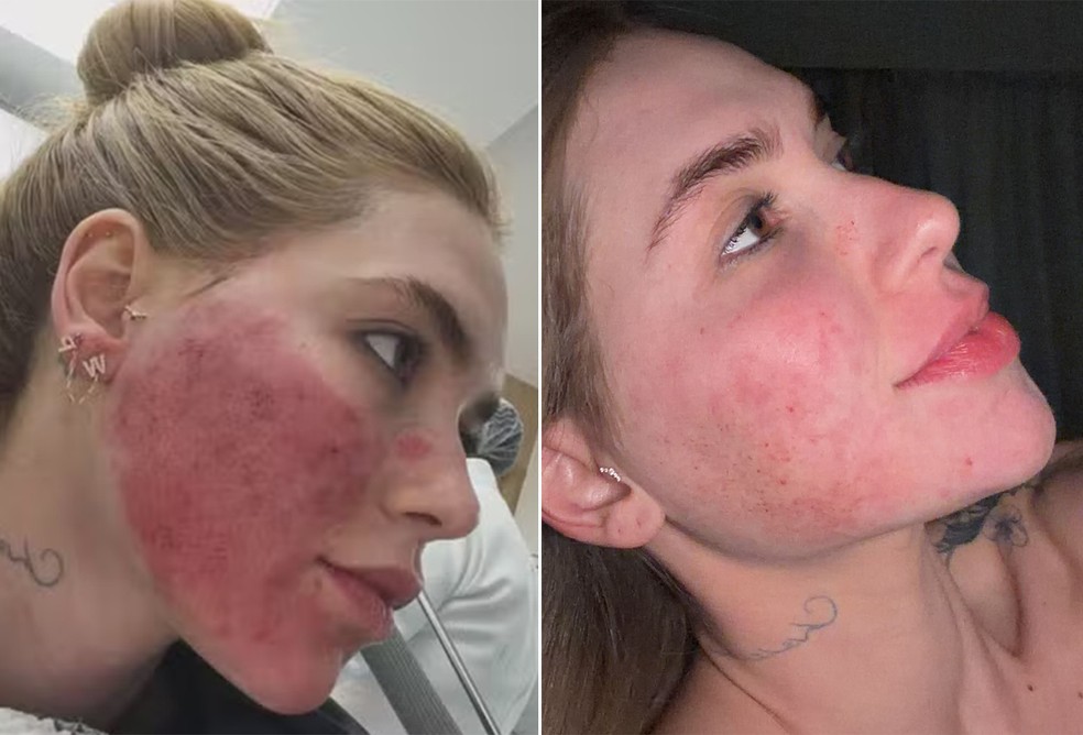 Virginia Fonseca mostra rosto 3 dias após procedimento que o deixou em 'carne viva' — Foto: Reprodução/Instagram