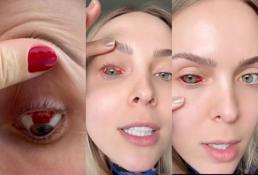 Tata Estaniecki atualiza situação do olho dez dias após derrame ocular;  vídeo