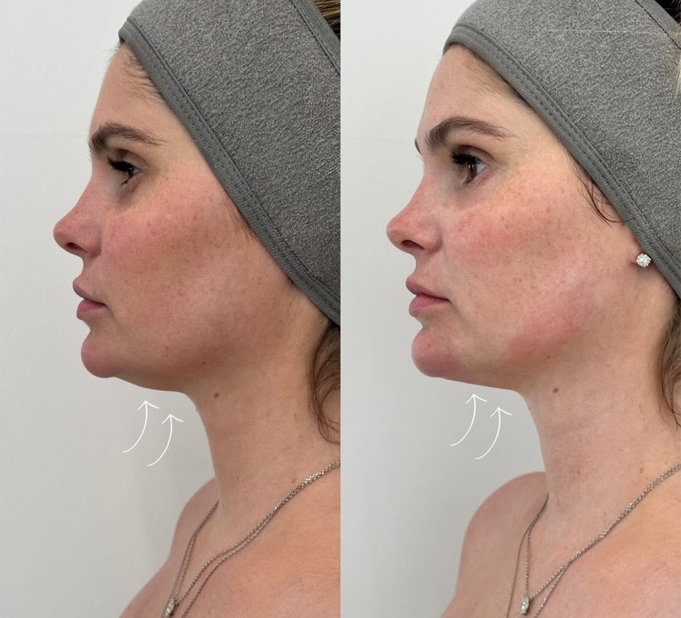 Bárbara Evans também fez procedimento estético para diminuir papada — Foto: Reprodução/Instagram