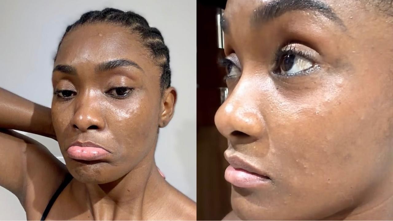 Erika Januza tem reação alérgica após refeição: 