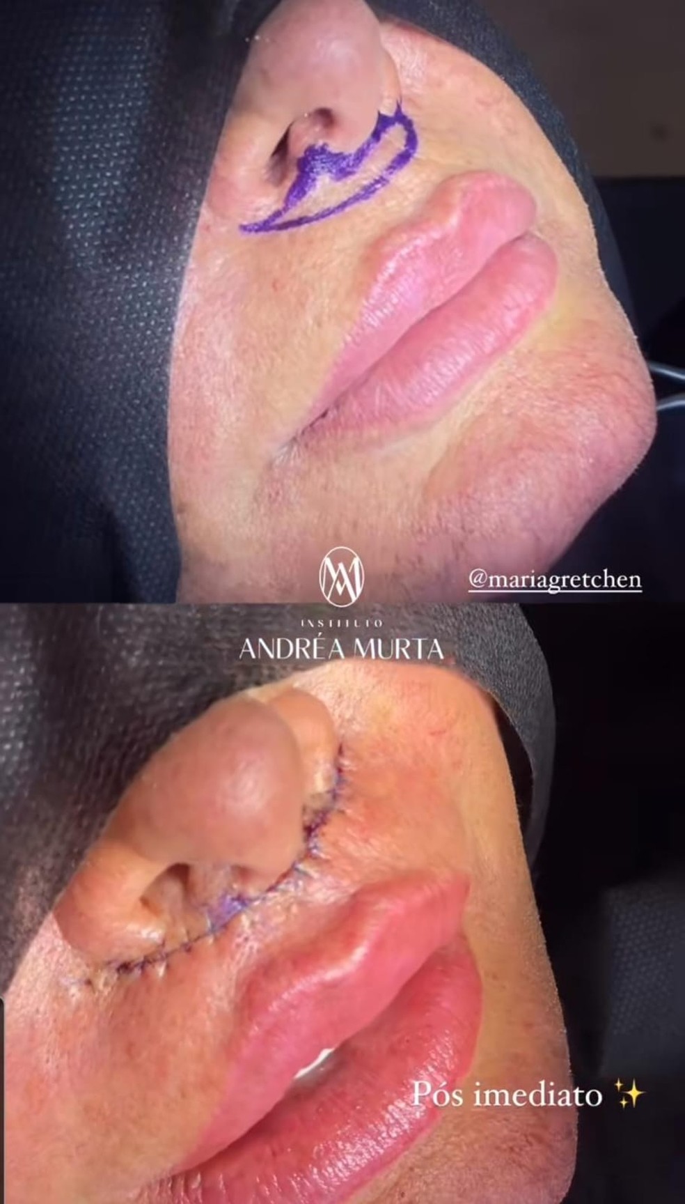Gretchen: antes e depois — Foto: Reprodução/Instagram