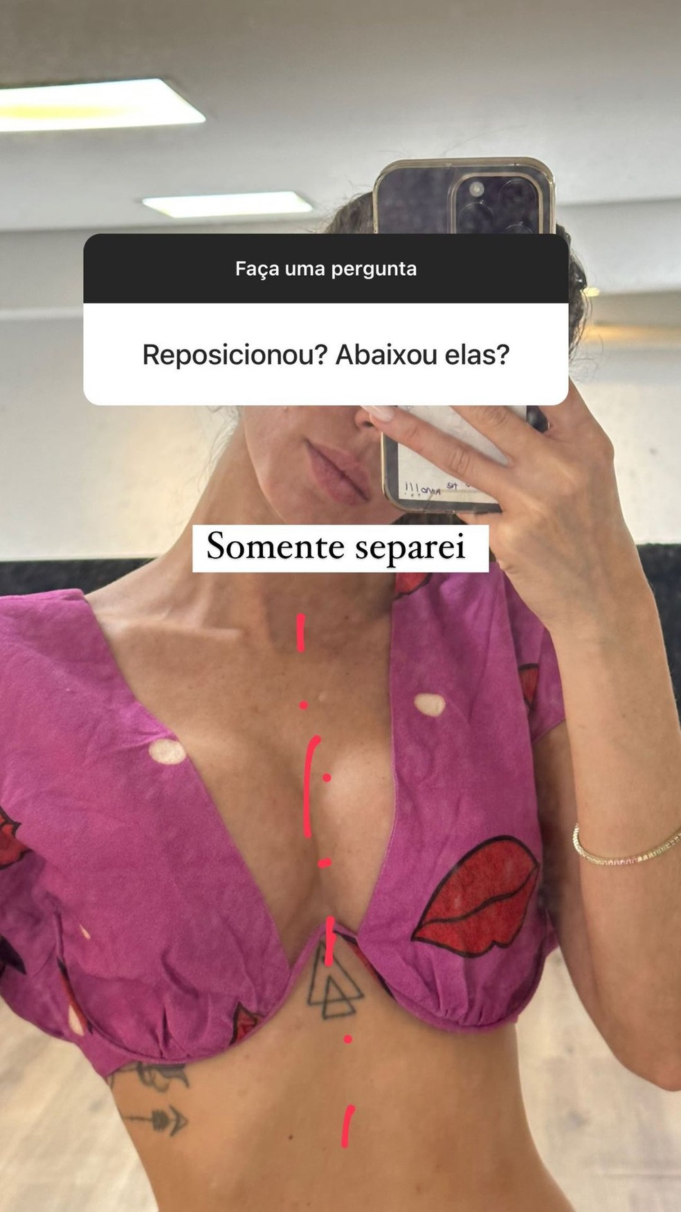 Maria Lina fala de procedimento para reposicionar pr&oacute;teses de silicone &mdash; Foto: Instagram