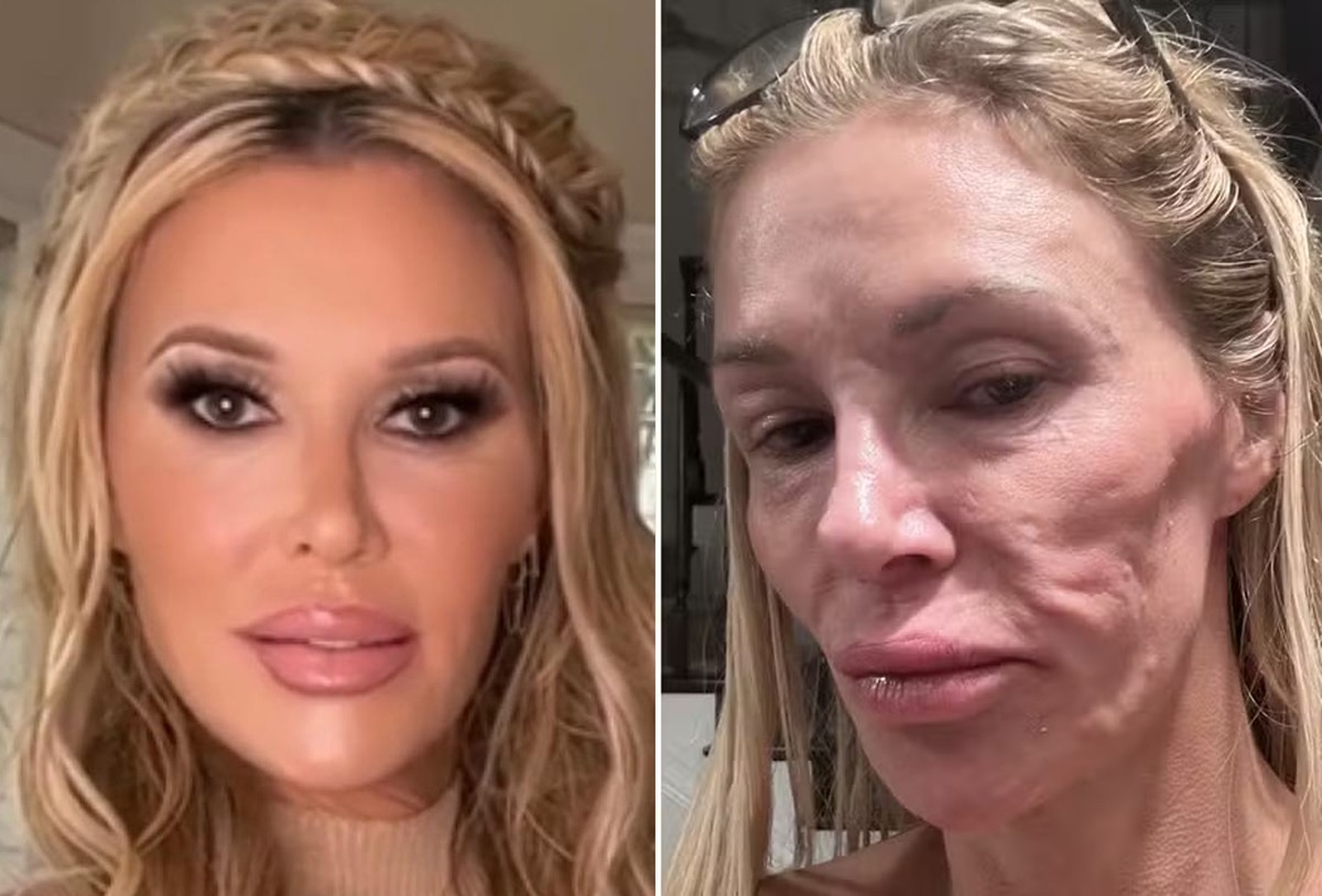 Brandi Glanville Fala Abertamente Sobre Saúde Mental e Batalha Contra Parasita Facial