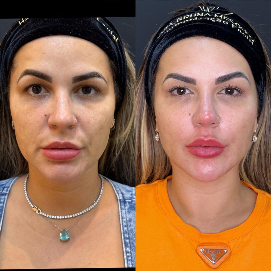 O antes e depois de Deolane Bezerra — Foto: Reprodução Instagram