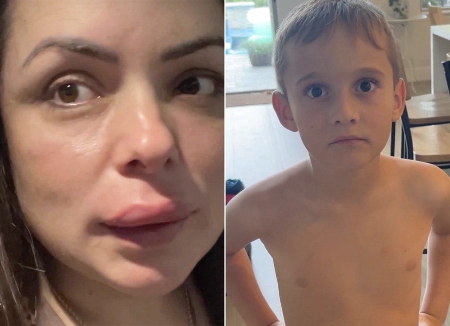 Flavia Calina mostrou a reação dos filhos ao chegar com a boca inchada após procedimento
