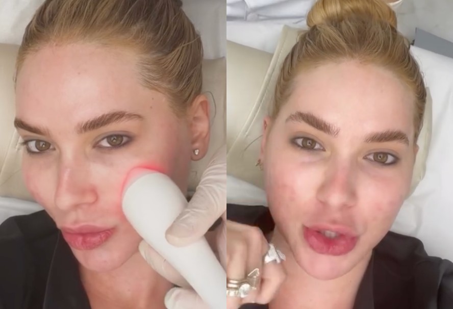 Na 'carne viva'! Virginia choca ao mostrar pele após procedimentos estéticos; veja como ficou!