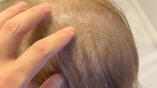 Simony mostra novo visual e queda de cabelos por causa de tratamento contra câncer