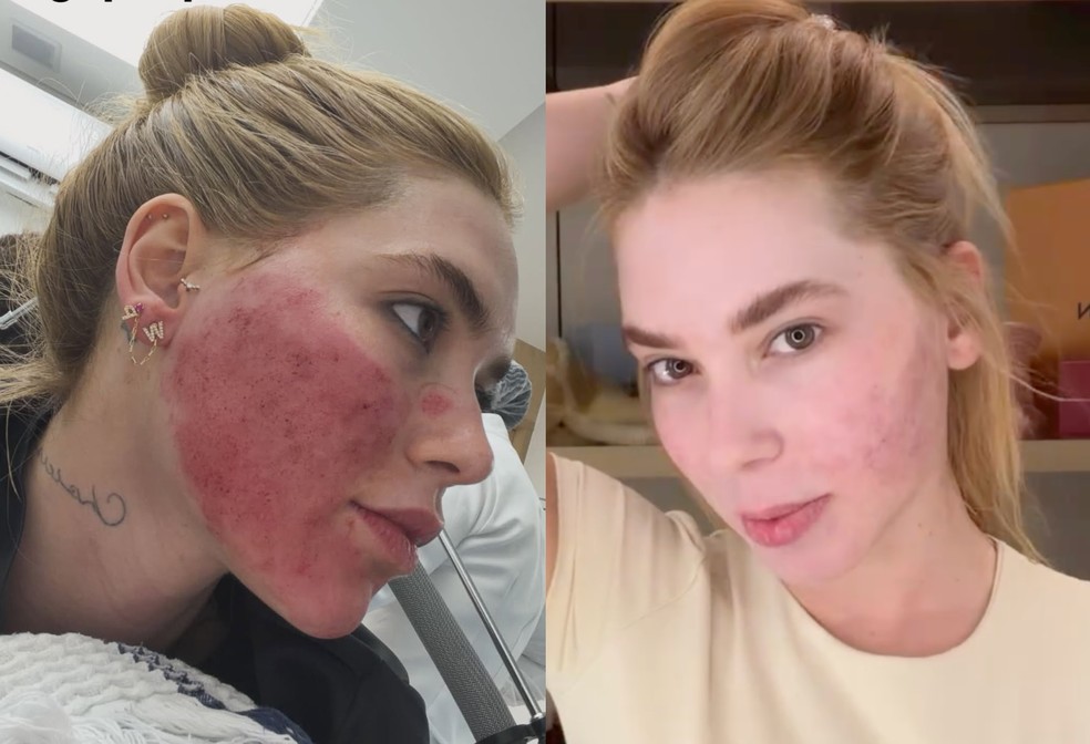 Antes e depois de Virginia — Foto: Reprodução/Instagram