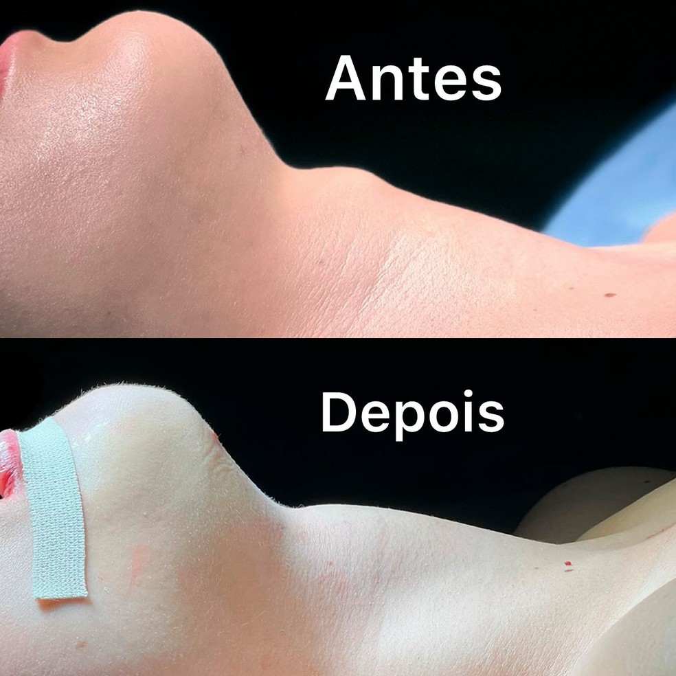 Zé Longuinho mostra antes e depois de procedimento estético — Foto: Reprodução/Instagram
