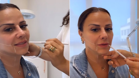 Viviane Araújo faz procedimento estético no rosto a quatro meses do Carnaval; vídeo