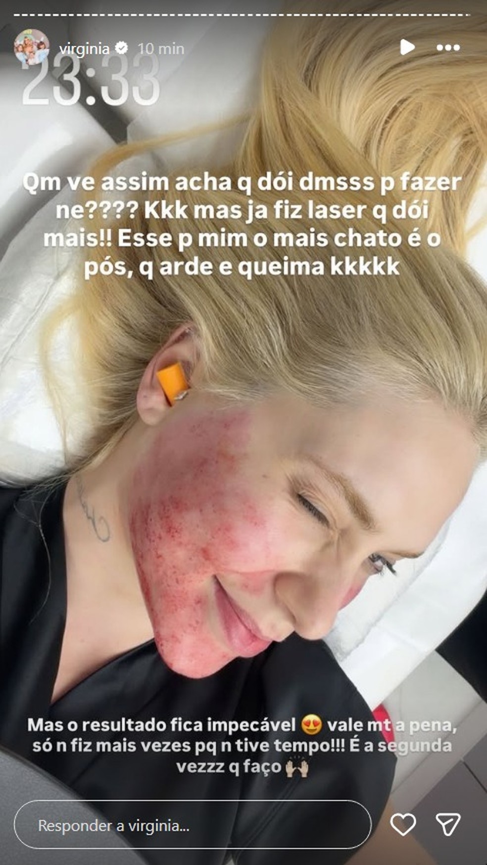 Virginia Fonseca após procedimento estético para tratar acnes — Foto: Reprodução/Instagram