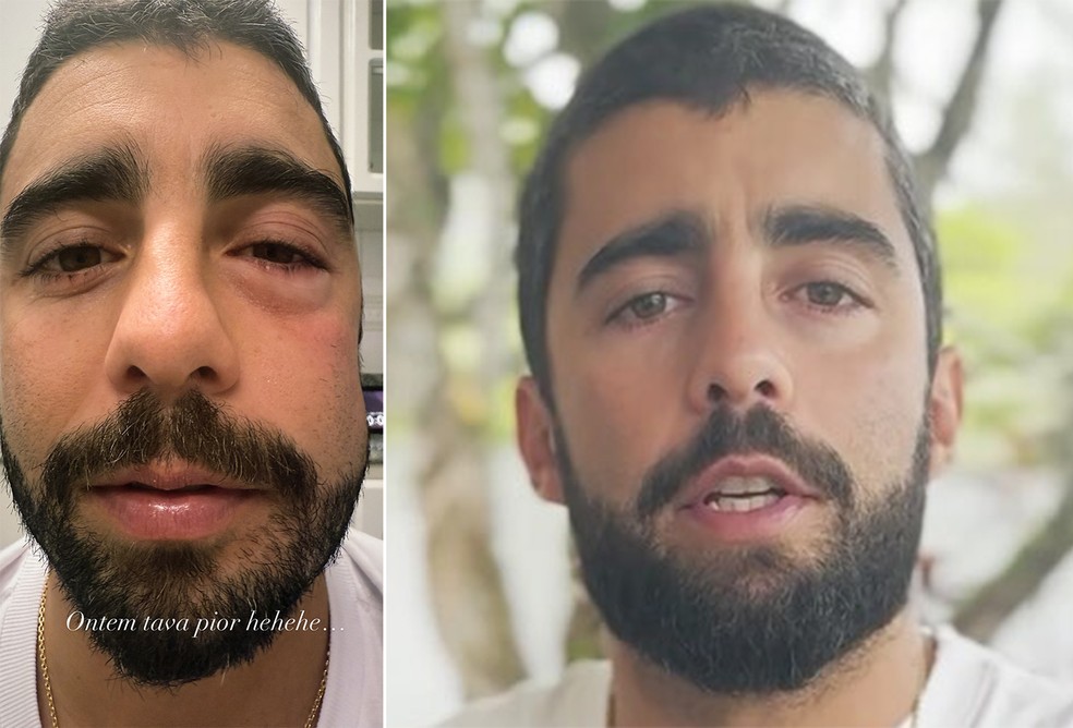 Pedro Scooby exibe rosto inchado e explica motivo; assista ao vídeo