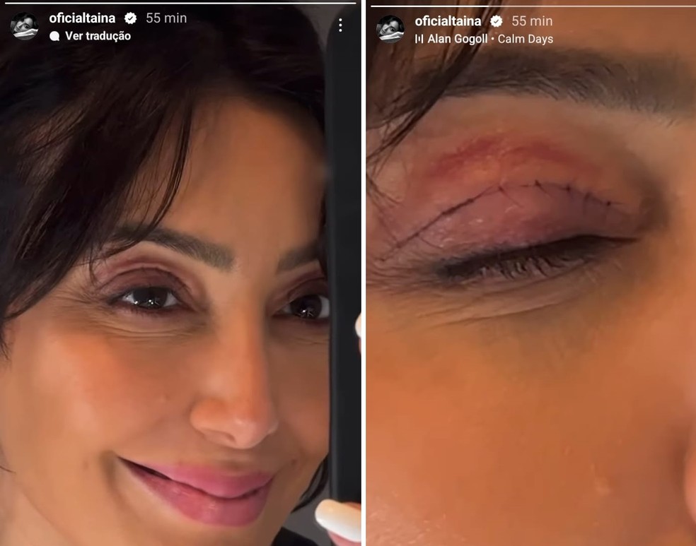 Tainá Galvão mostra recuperação de blefaroplastia, cirurgia nas pálpebras — Foto: Reprodução/Instagram