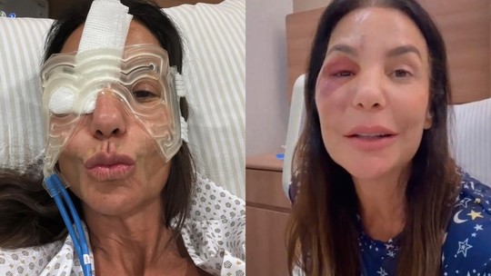 Ivete Sangalo surge com 'cabeça de gelo' e mostra recuperação após cirurgia no rosto Ivete Sangalo surge com 'cabeça de gelo' e mostra recuperação após cirurgia no rosto