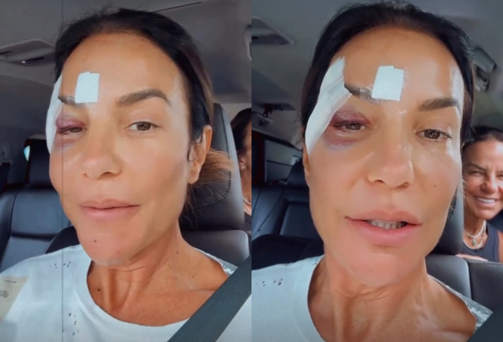 Ivete Sangalo no dia seguinte à queda — Foto: Reprodução/Instagram