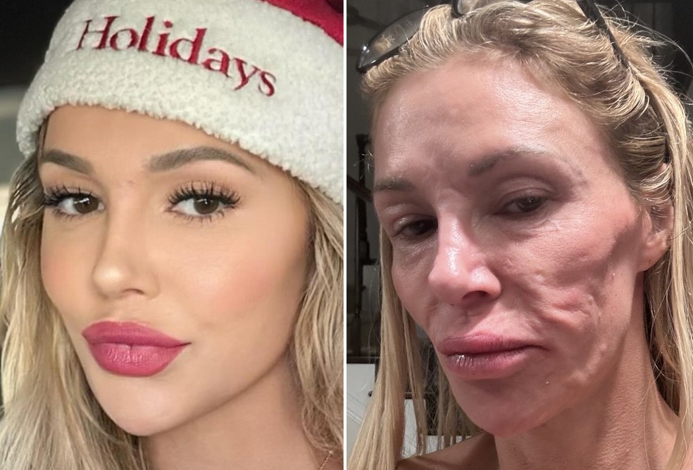 Ex-modelo Brandi Glanville mostra rosto 'derretido' e preocupa fãs — Foto: Reprodução/Instagram