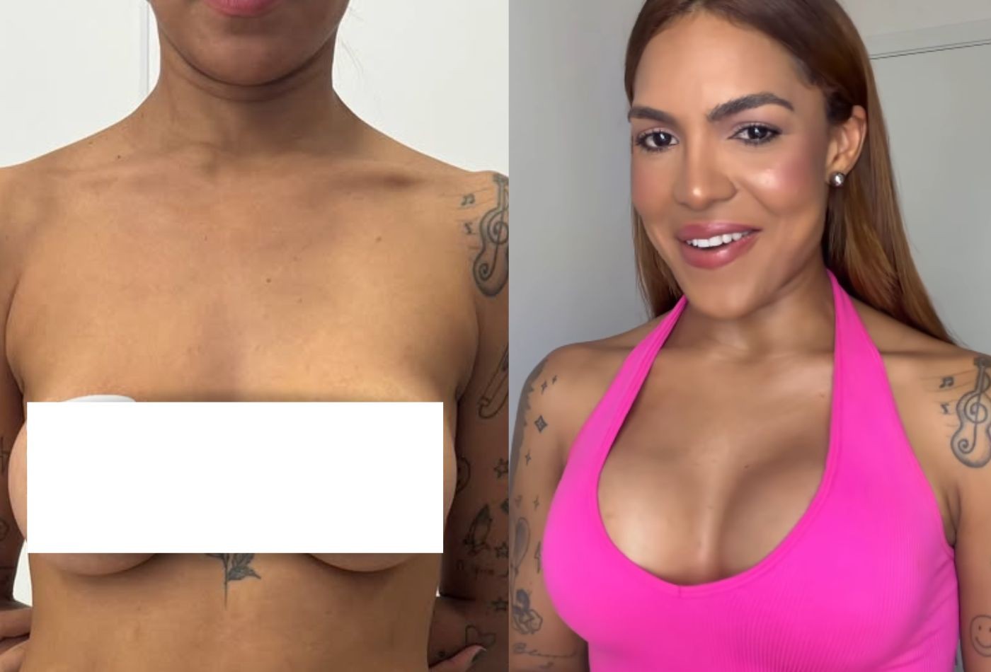 Tays Reis troca próteses de silicone após 11 anos e mostra resultado de cirurgia: 'Meu primeiro decotinho'