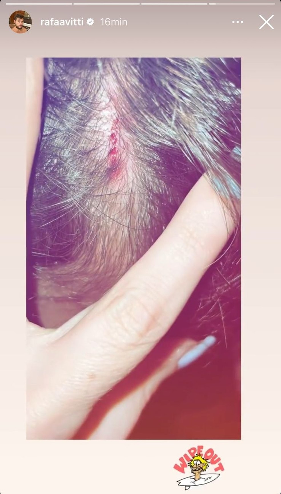 Rafael Vitti se machuca durante surfe — Foto: Reprodução / Instagram