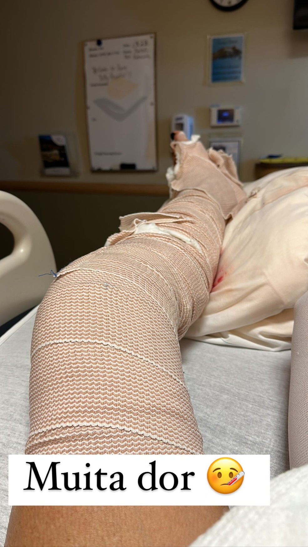 Luciana Gimenez mostra perna quebrada — Foto: Reprodução / Instagram