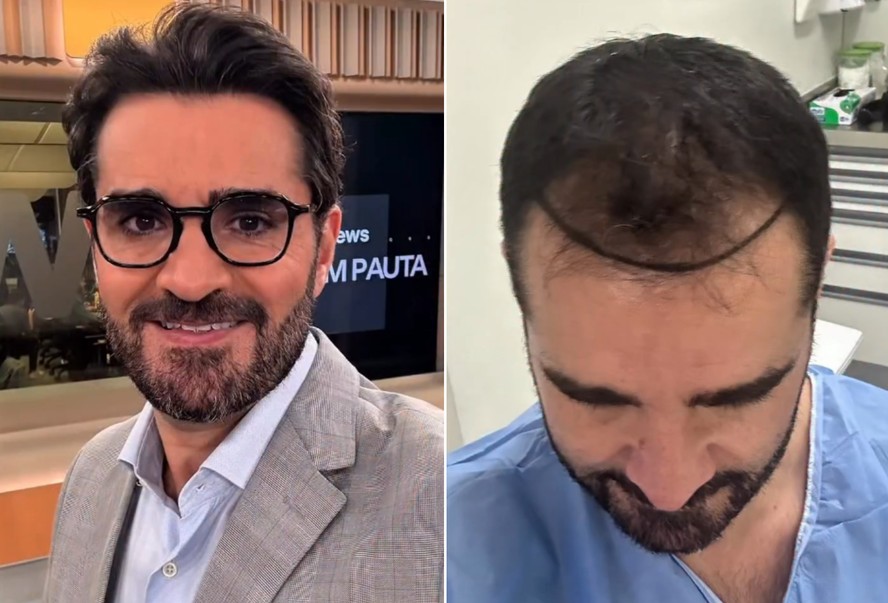 Apresentador da GloboNews Marcelo Cosme mostra antes e depois de transplante capilar
