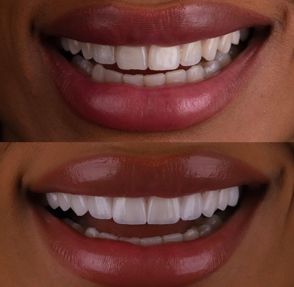 O antes e depois do sorriso de Brunna Gonçalves — Foto: Reprodução Instagram