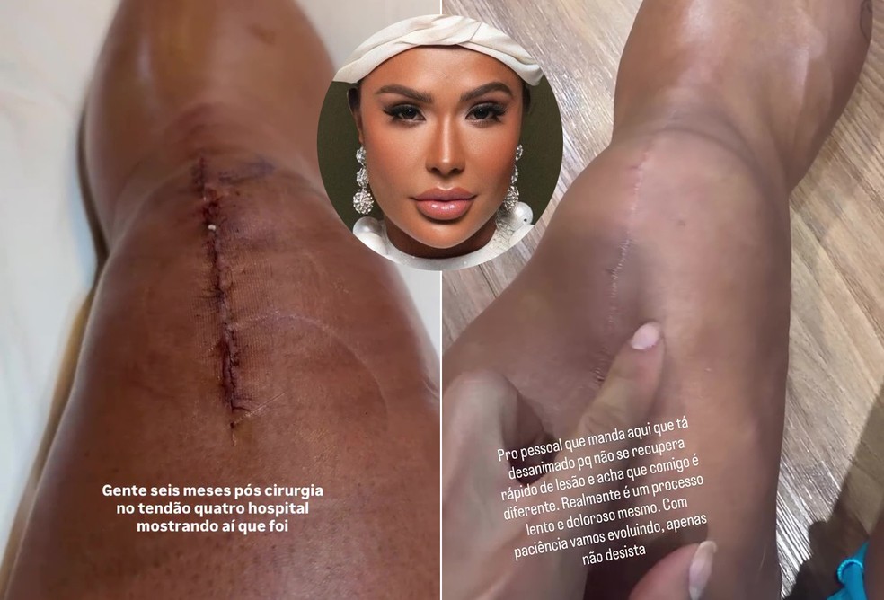 Gracyanne faz balanço seis meses após cirurgia no joelho — Foto: Reprodução/Instagram