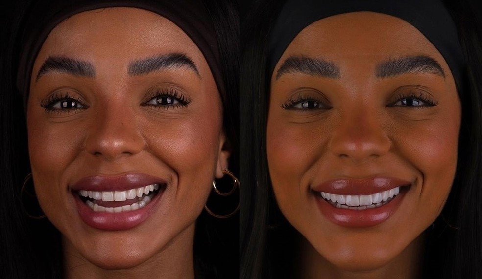 O antes e depois do sorriso de Brunna Gonçalves — Foto: Reprodução Instagram