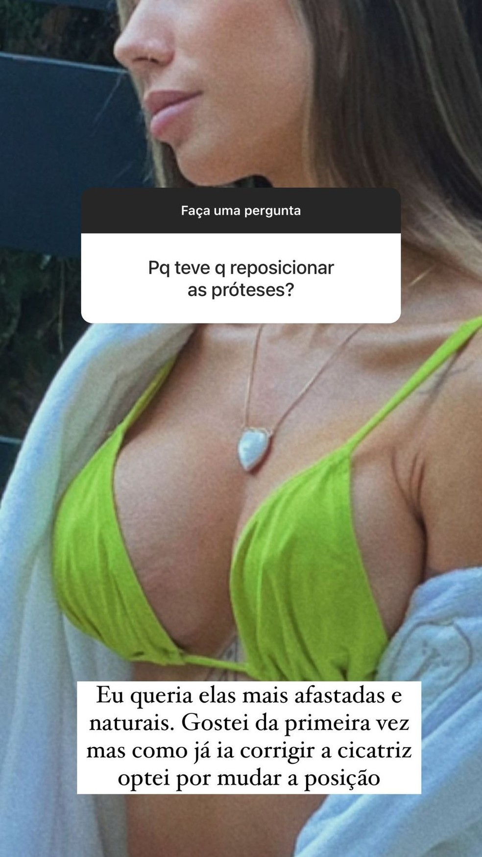 Maria Lina fala de procedimento para reposicionar pr&oacute;teses de silicone &mdash; Foto: Instagram