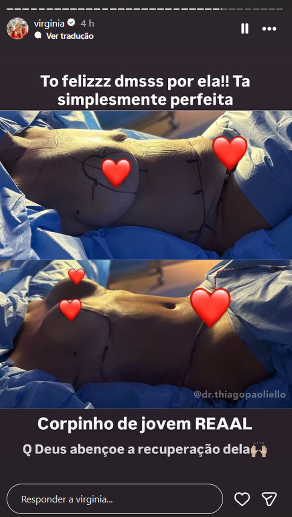 Corpo de Margareth Serrão após procedimentos — Foto: Reprodução/Instagram