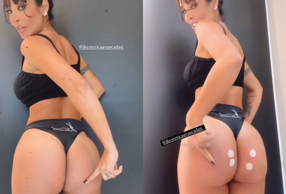 Carol Nakamura mostra antes e depois de procedimento no bumbum — Foto: Reprodução/Instagram