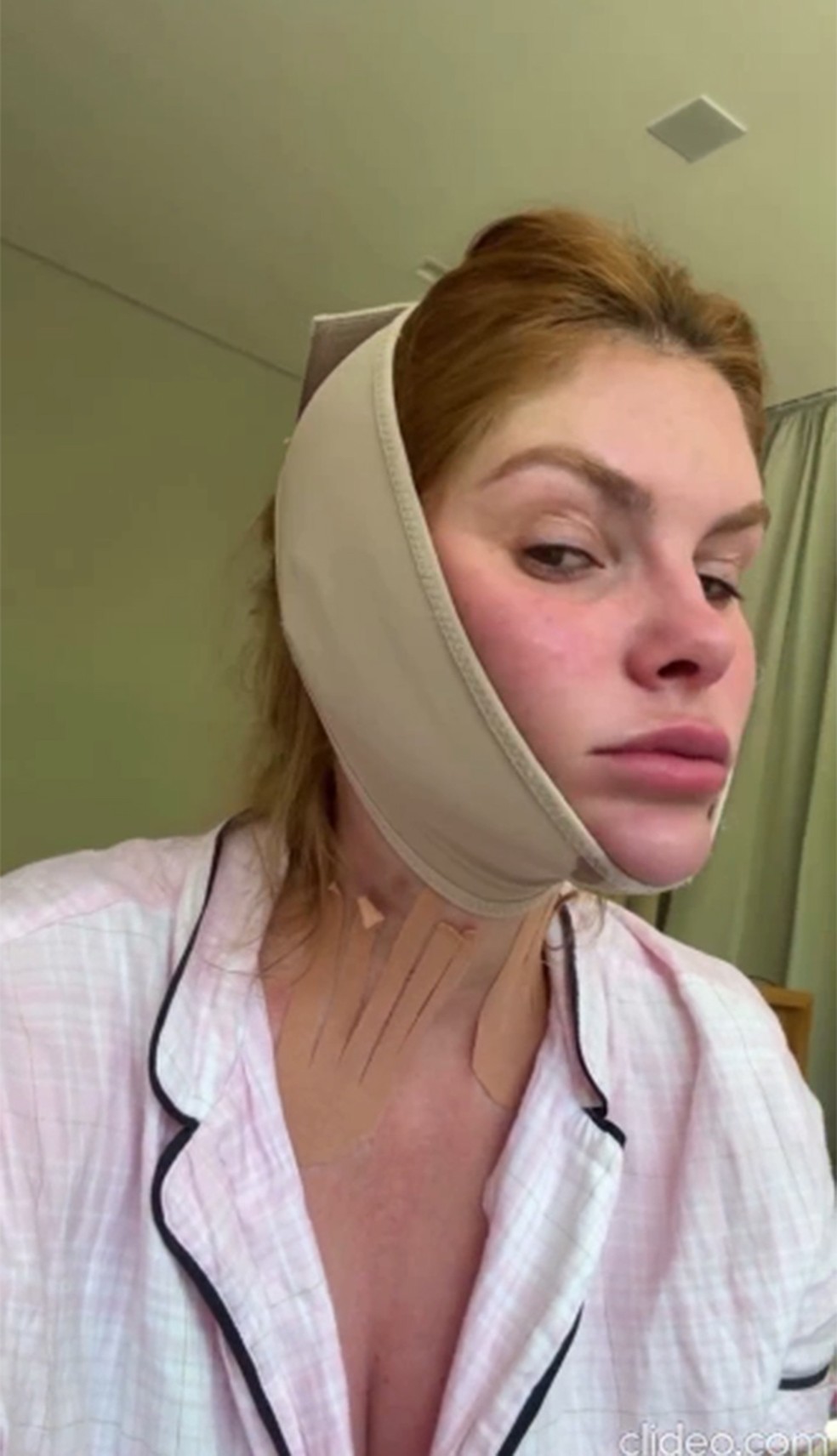 Bárbara Evans recorre a técnica para diminuir papada — Foto: Reprodução/Instagram