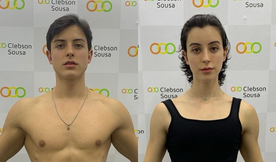 Redesignação De Gênero Antes E Depois