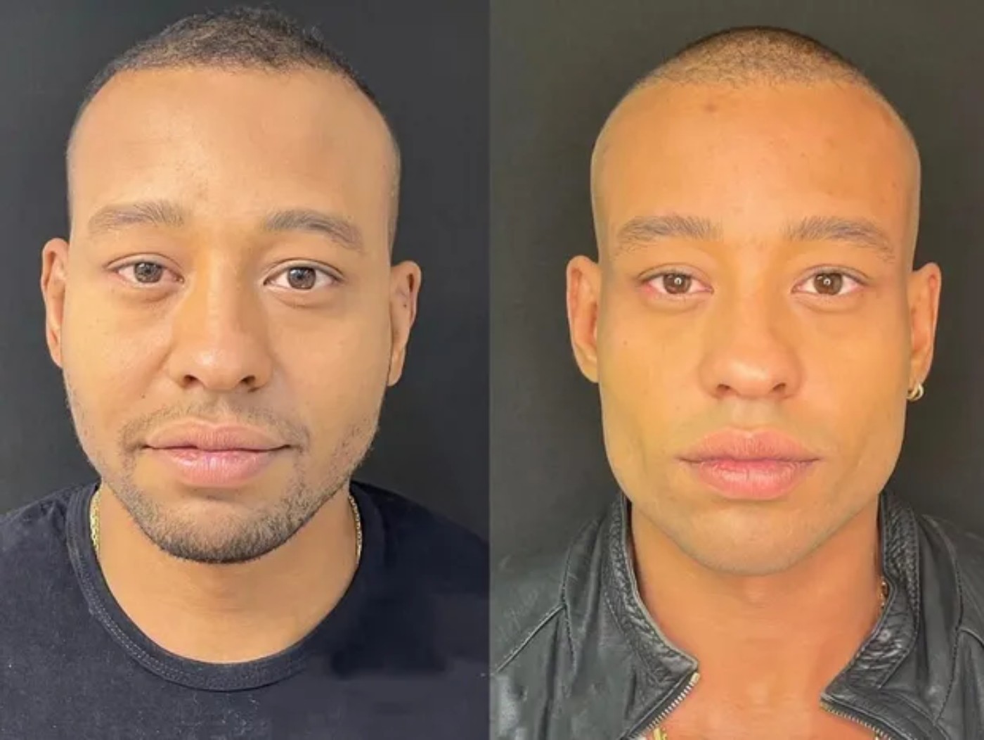 Antes e depois da harmonização facial de Mussunzinho  — Foto: Divulgação/JK Estética