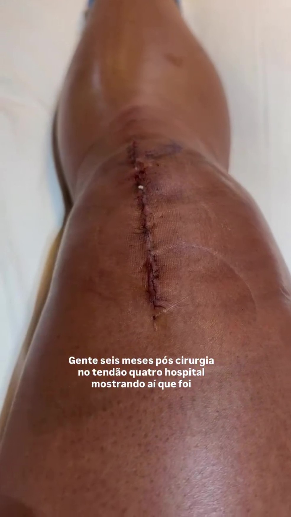 Gracyanne faz balanço seis meses após cirurgia no joelho — Foto: Reprodução/Instagram