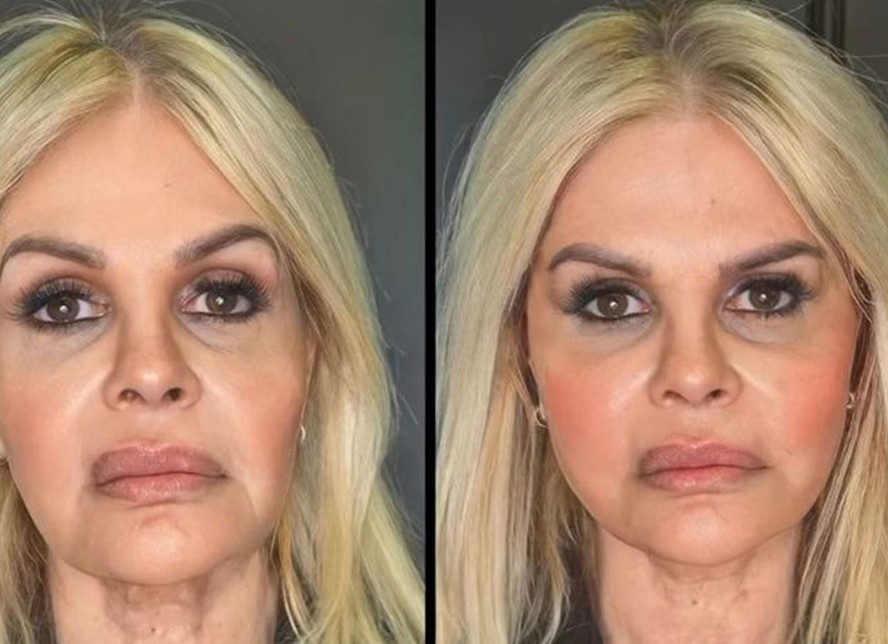 Monique Evans compartilha resultado de harmonização facial 'Chocada e