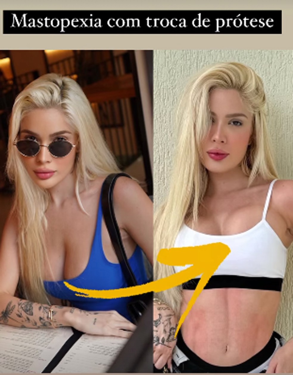 Karoline Lima antes e depois de plsticas nos seios  Foto: Reproduo/Instagram