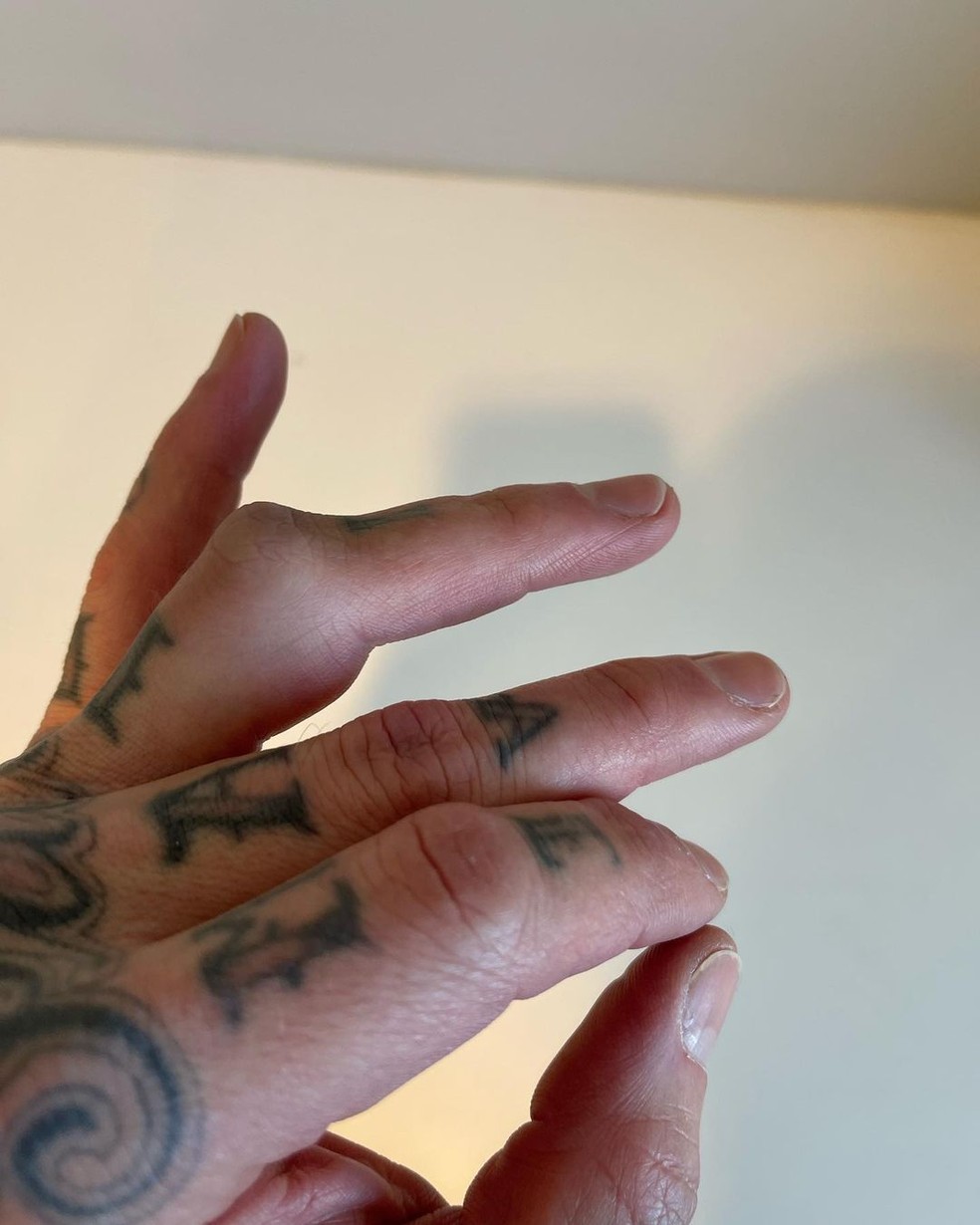 Travis Barker mostra dedo machucado — Foto: Reprodução/Instagram